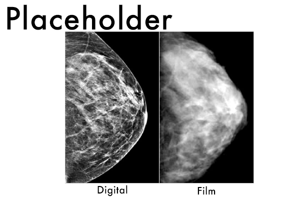 Mammography placeholder digital and film